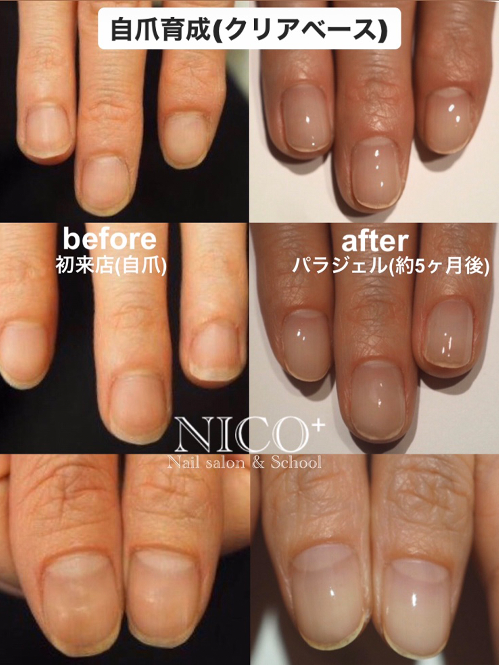 自爪育成実例 爪の傷み具合や癖に合わせた施術 Nico ニコプラス 自爪育成実例 爪の傷み具合や癖に合わせた施術 Nico ニコプラス